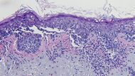 Histopathology of lentigo maligna melanoma.jpg