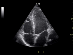 Ultrasound of human heart apical 4-cahmber view.gif