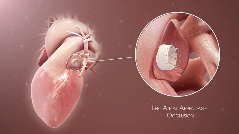 File:3D Medical Animation of Left Atrial Appendage Occlusion.jpg