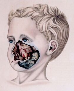 Drawing of boy with gangrene around mouth, nose, cheek
