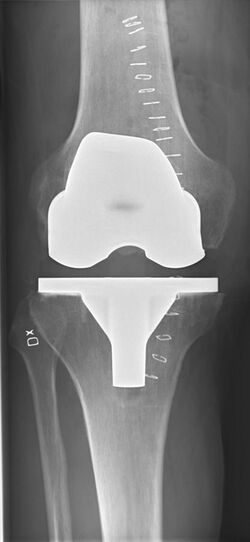 Postoperative X-ray of normal knee prosthesis, anteroposterior view.jpg