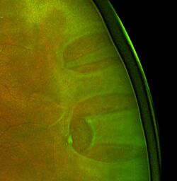 Rhegmatogenous retinal detachment