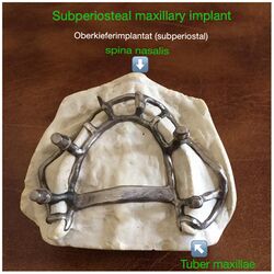 Subperiosteal maxillary implant.jpg