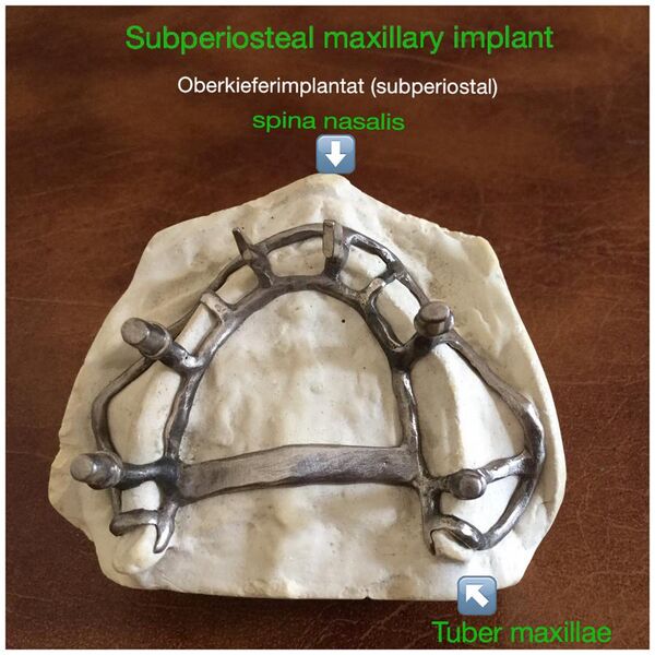 File:Subperiosteal maxillary implant.jpg
