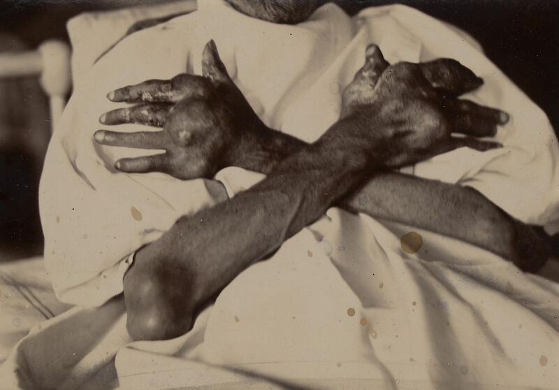 File:Tophaceous gout affecting the arms and hands Wellcome L0062959.jpg