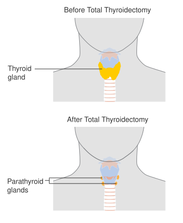 File:Diagram showing before and after a total thyroidectomy CRUK 106.svg