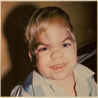 Mucopolysaccharidosis (Hurler's Syndrome) 1.jpg