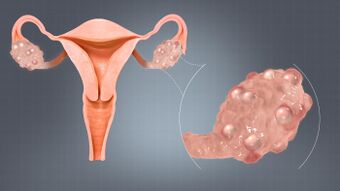 Polycystic Ovaries.jpg