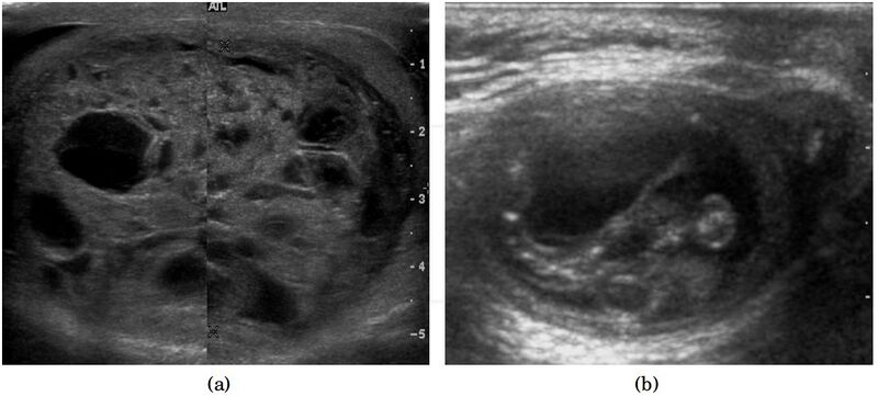 File:Ultrasonographies of mature cystic teratomas.jpg