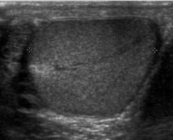 Ultrasonography of a normal testicle.jpg