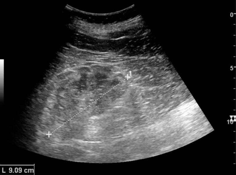 File:Ultrasonography of chronic renal disease caused by glomerulonephritis.jpg