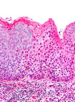 Vulvar intraepithelial neoplasia3 1.jpg