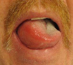 Angioedema2013.JPG