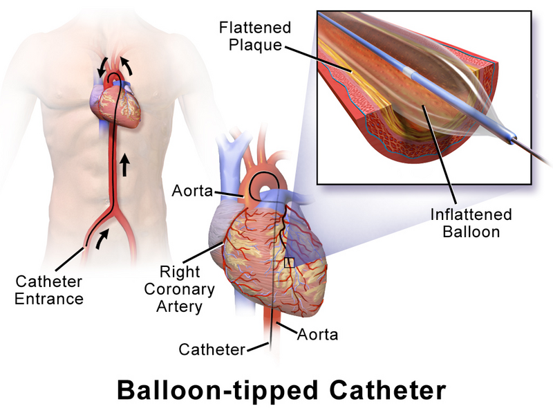 File:Balloon-Tipped Catheter.png