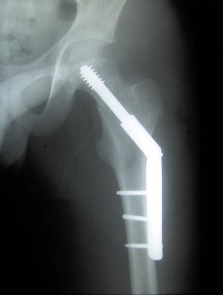 File:Cdm hip implant 348.jpg
