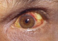 Conjunctival suffusion of the eyes due to leptospirosis.jpg