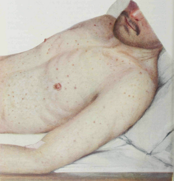 Epidemic Typhus. Macular rash.png
