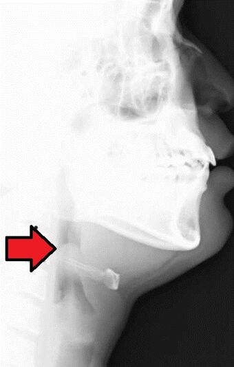 Epiglottitis.jpg