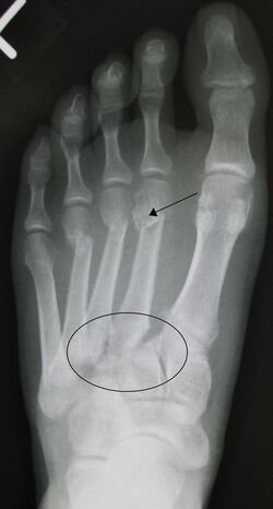 Lisfranc fracture.jpg