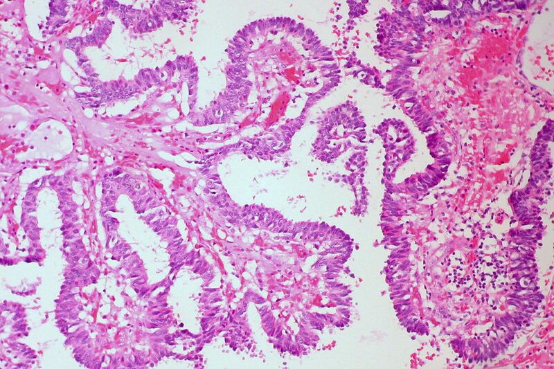 File:Encapsulated Papillary Carcinoma of the Breast, H&E (15768688957).jpg