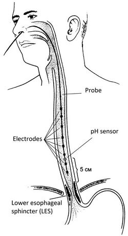 Impedance–pH monitoring.jpg