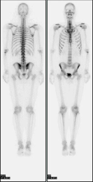 File:Nl bone scan2.jpg
