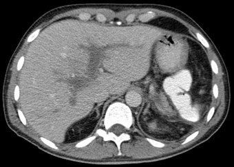 Pfortaderthrombose001.png