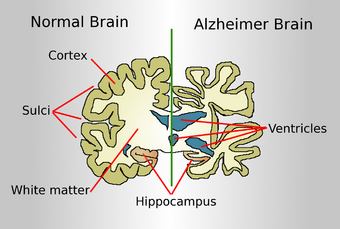 Brain-ALZH.png