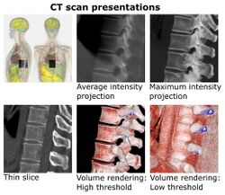CT presentation as thin slice, projection and volume rendering.jpg