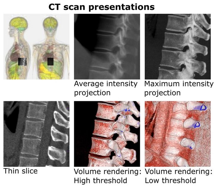 File:CT presentation as thin slice, projection and volume rendering.jpg