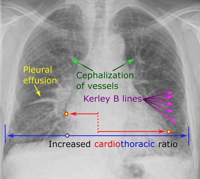 File:Chest radiograph with signs of congestive heart failure - annotated.jpg