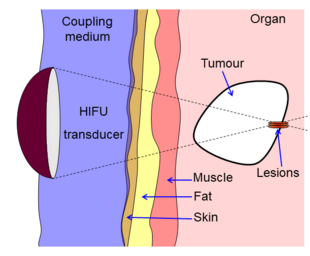 Diagram showing liver lesioning using a HIFU transducer 2.png
