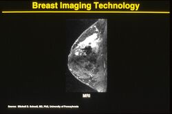 Mri of breast cancer.jpg