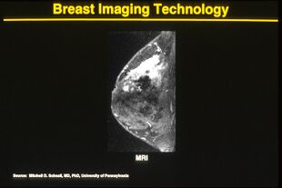 Mri of breast cancer.jpg