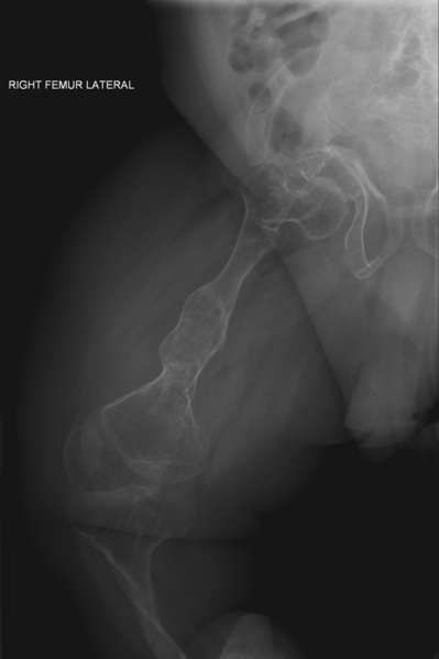 File:Osteogenesis imperfecta X-ray (clinically type IV) of right femur.png