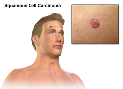 Squamous Cell Carcinoma.png