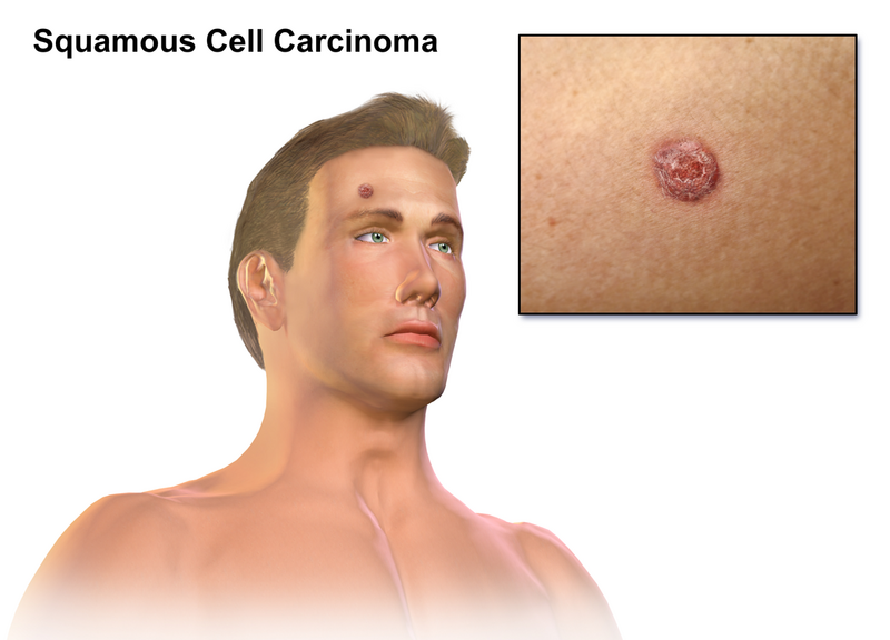 File:Squamous Cell Carcinoma.png