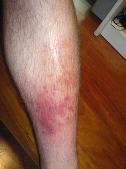 Cellulitis3.jpg