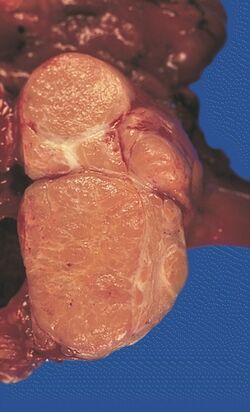 Locally invasive circumscribed thymoma.jpg