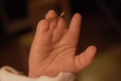 Amniotic band hand.jpg