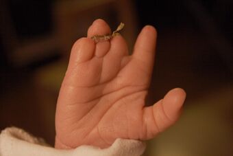 Amniotic band hand.jpg
