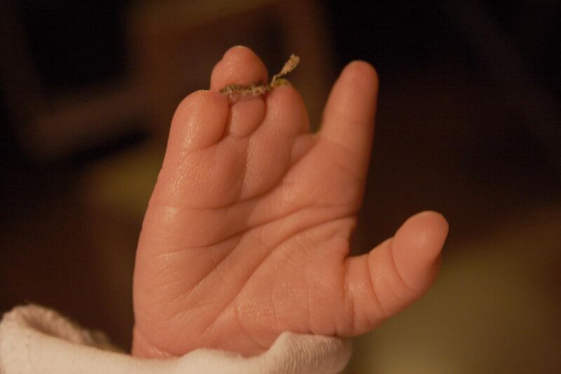 File:Amniotic band hand.jpg