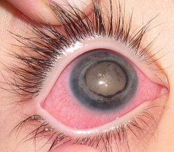 Eye of patient with Coats' disease.jpg