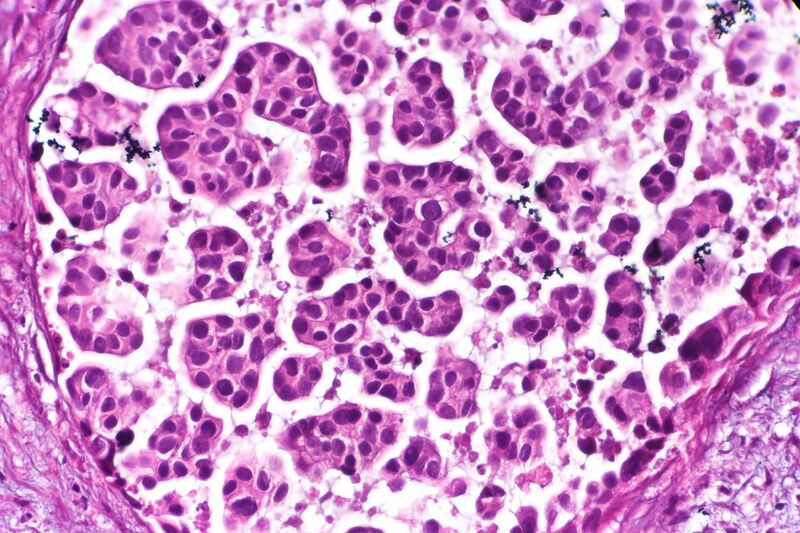 File:Micropapillary urothelial carcinoma, very high mag.jpg