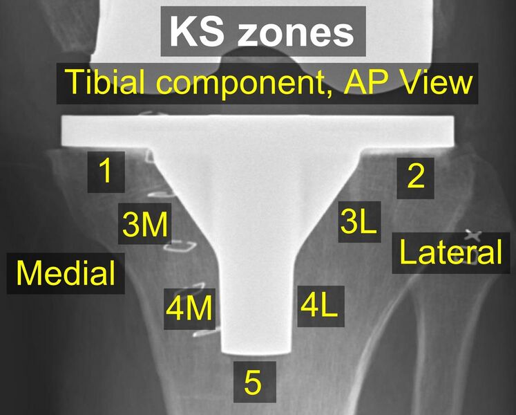 File:Knee prosthesis zones by Knee Society 2015, AP view.jpg