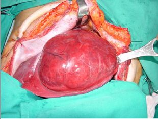 Liver lobectomy 02.jpg