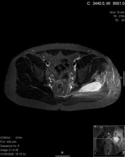 Pyomyositis MRI.jpg