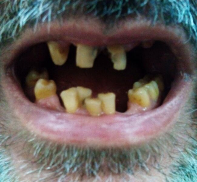 File:Tired teeth.jpg