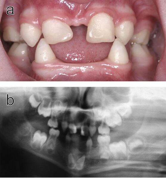 File:Dental abnormalities in a 5-year-old girl from north Sweden family who suffered from various symptoms of autosomal dominant hypohidrotic ectodermal dysplasia (HED).jpg