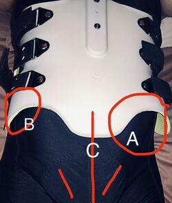 Full shell back brace - fitted to female adolescent.jpg